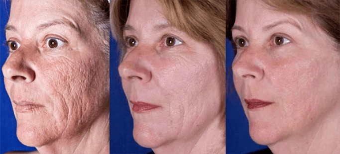 Результат після процедури лазерного омолодження шкіри обличчя