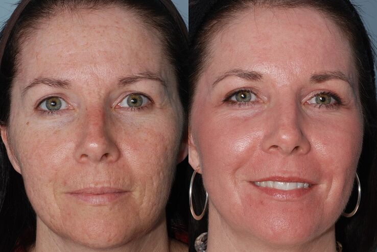до і після апаратного омолодження шкіри