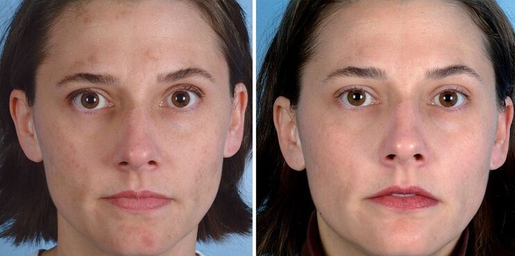 до і після омолодження шкіри апаратом