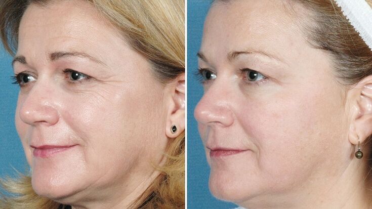фото до і після апаратного омолодження шкіри