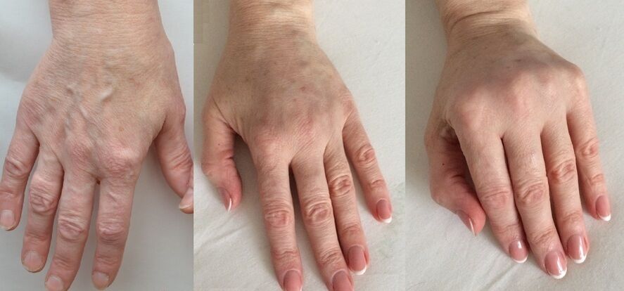 етапи омолодження шкіри рук