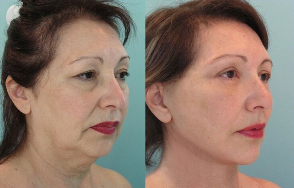 фото до та після омолодження шкіри обличчя