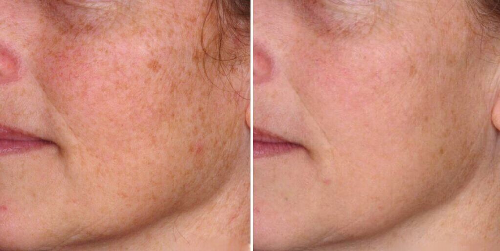 шкіра обличчя до та після омолодження